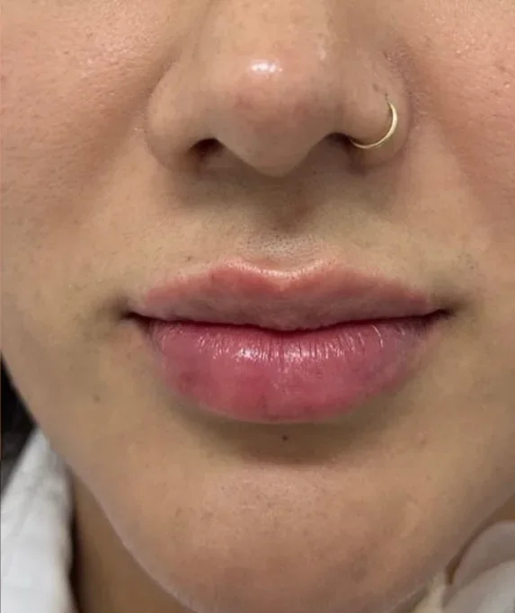 Aumento de labios: después